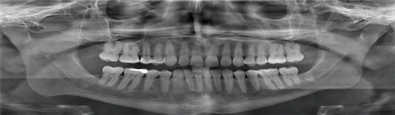  Painless Single Visit Root Canal